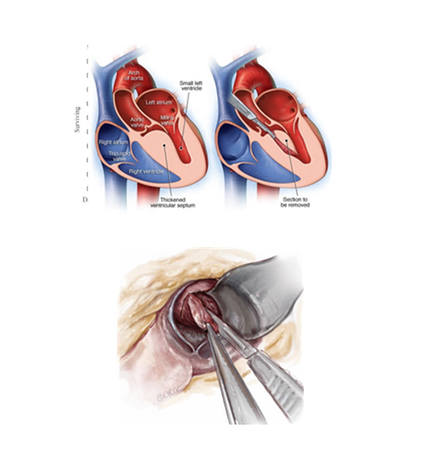 심근절제술의 개요와 개흉수술을 통한 심근 절제